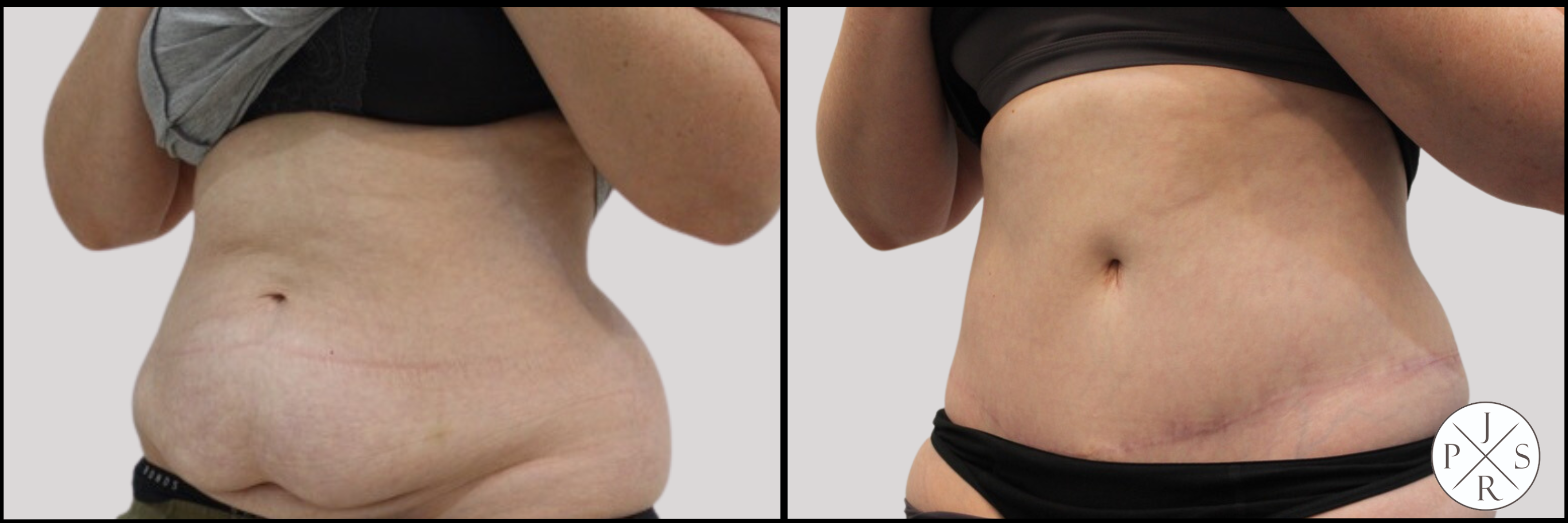 Abdominoplasty Before & After Image